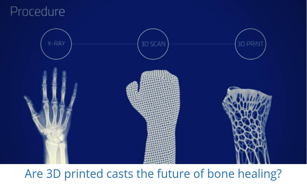 Can Additive Manufacturing heal bones with a 3D printed cast? | Sculpteo Blog