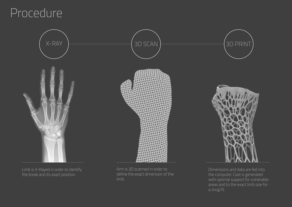 dezeen_Cortex-3D-printed-cast-for-broken-bones-by-Jake-Evill-6_1000