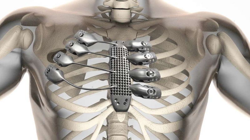 Stampa 3D per l'industria medica, sterno stampato in 3D da Anatomics