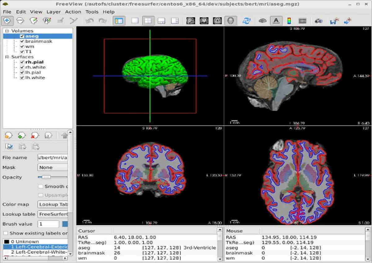 What Is Difference Between Mri And Ct Scan Of Brain Mri Scan Machine