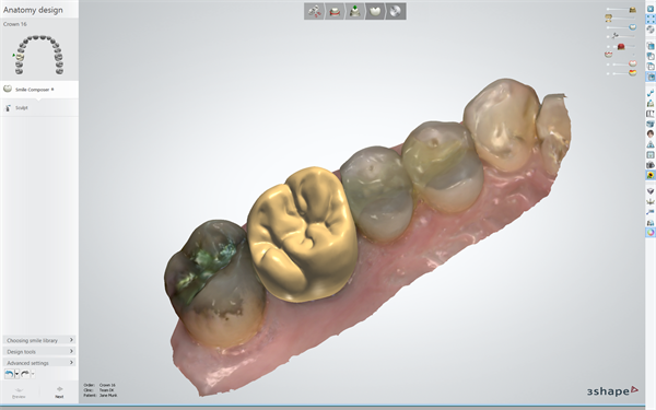 3-D Printer Uses Metal To Make Custom Rib Cage For Cancer Patient