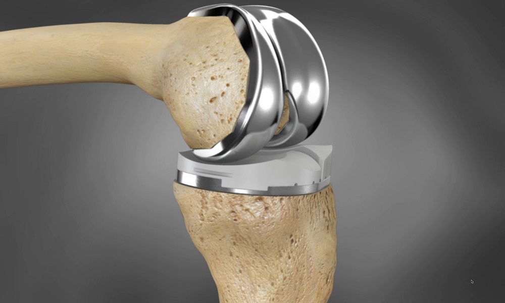 knee joint replacement devices