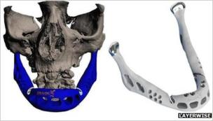 3D printed jaw