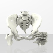 Hip and Pelvis Fracture  - sku 214