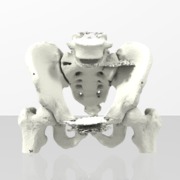 Hip and Pelvis Fracture  - sku 215
