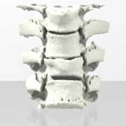 Thoracic  Spine - Fracture - sku 149
