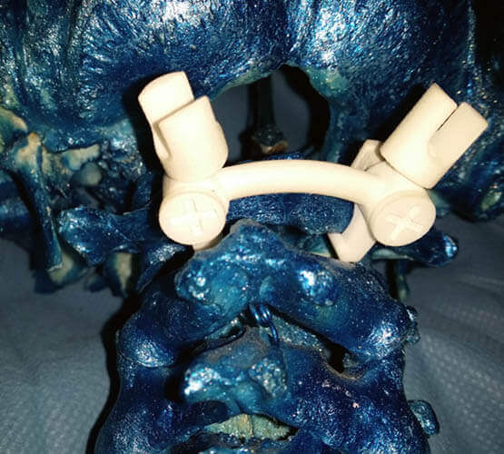 3D_printed_implant_for_the_medical_industry_exemple_qff98pr.jpg 3D_printed_implant_for_the_medical_industry_exemple_qff98pr.jpg