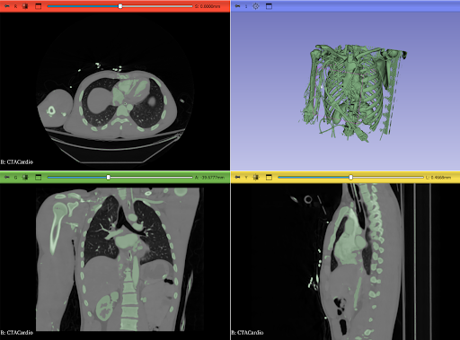 Slicer 3D segmentation