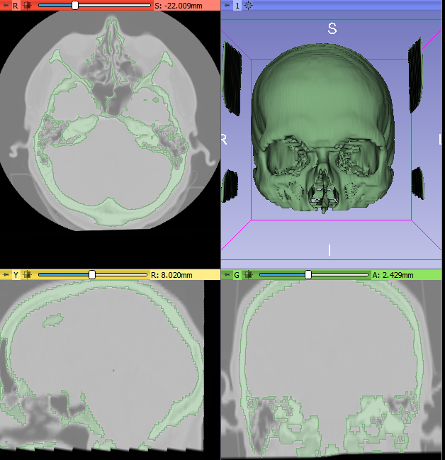 3d slicer segmentation medical modeling